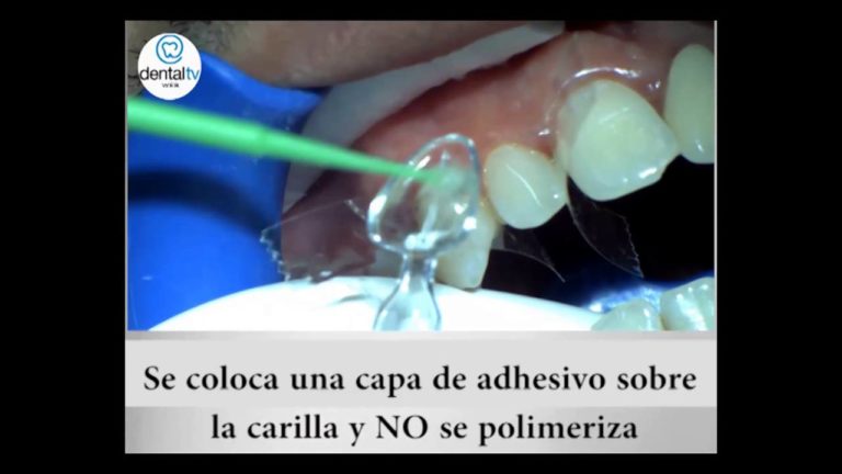 Como hacer una carilla dental con una plantilla Paso a paso
