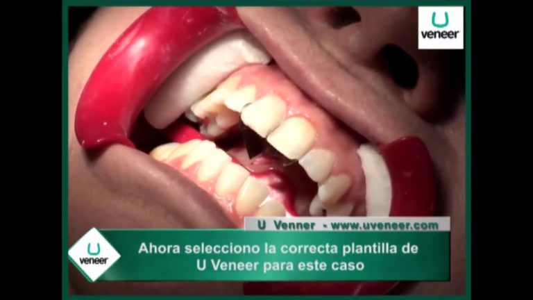 Como trabajar con las plantillas para carillas dentales U Veneer