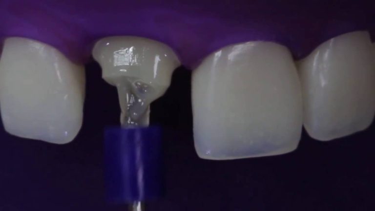 Colocacion de Postes de Fibra de Vidrio en canal radicular Paso a Paso