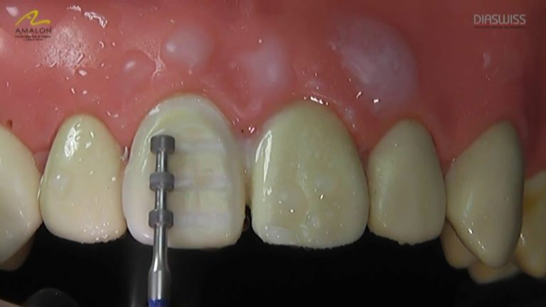 Tallado para una Carilla Dental , Paso a Paso