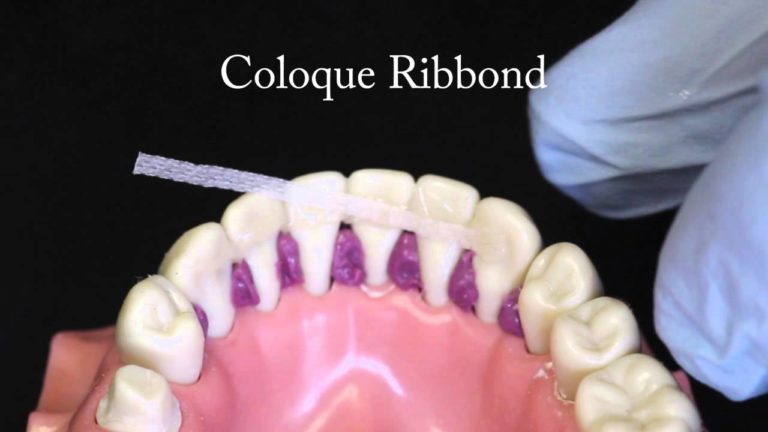 Como hacer una ferula periodontal reforzada con cinta de fibra