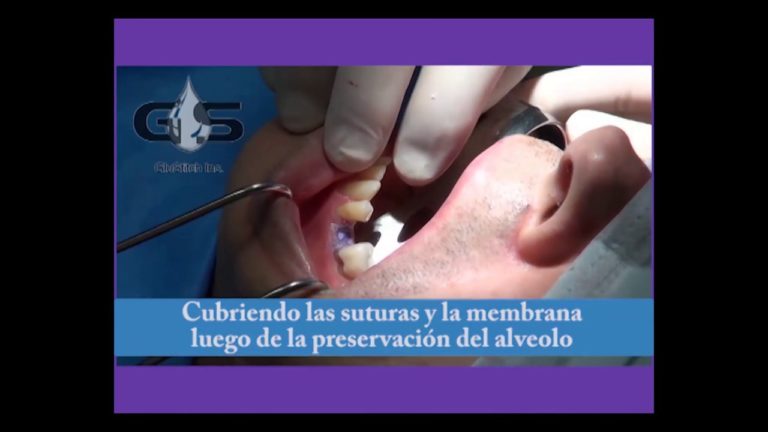 Como usar el PeriAcryl para post cirugias dentales