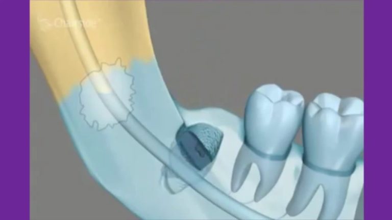 Complicaciones de la exodoncia dental