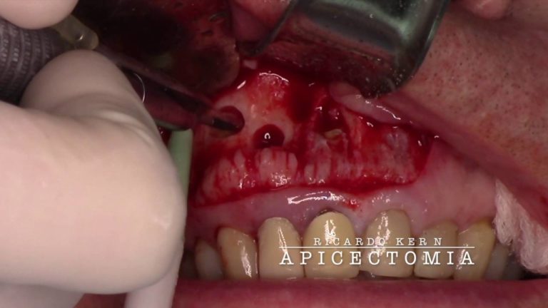 Como hacer varias apicetomias juntas. Paso a paso
