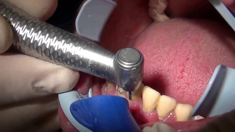 Fresa Talon, la fresa que mejor corta metales dentales de TriHawk