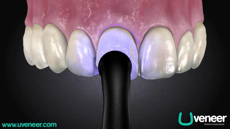 Estetica Dental: Carillas AnteroSuperiores con plantillas Uveneer, animacion 3 D