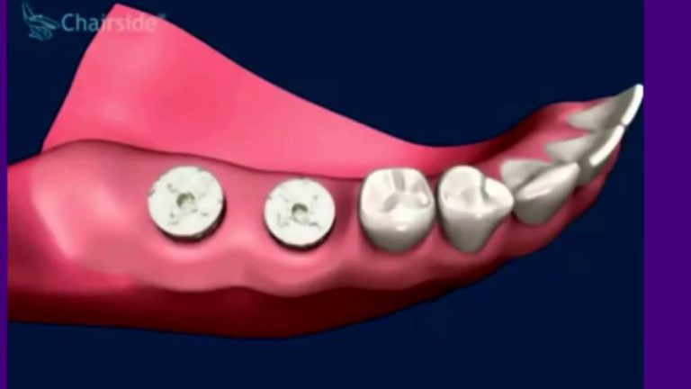 Endocarditis infecciosa en diversas situaciones bucales