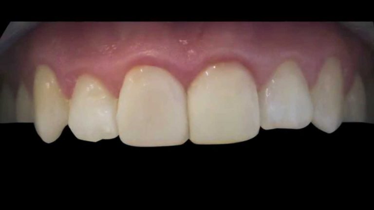 Carillas Dentales Directas en Minutos