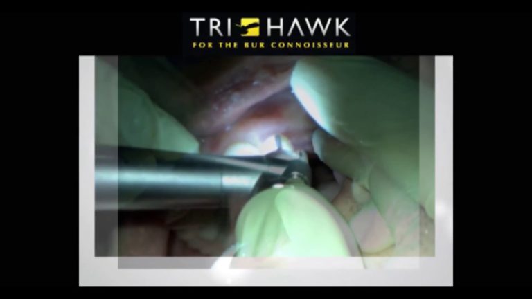 Como cortar una corona dental para sacarla