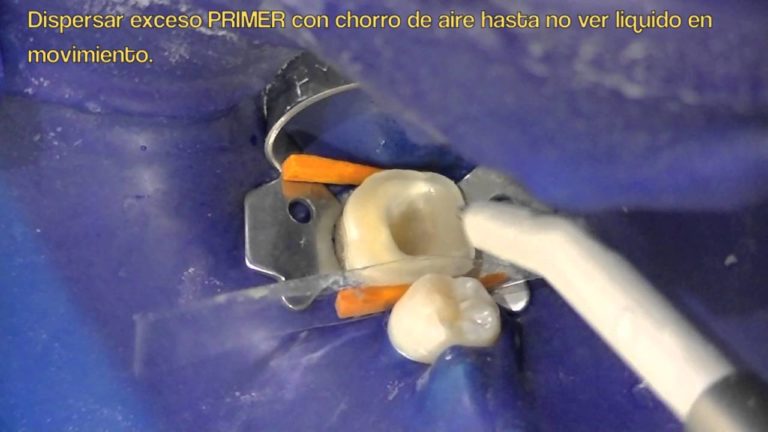 Como cementar incrustacion dental overlay composite o ceromero