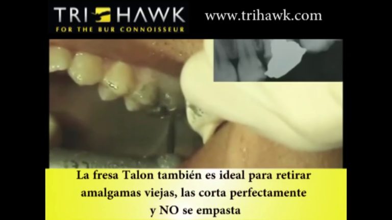 Porque la fresa Talon es la mejor para cortar metales dentales