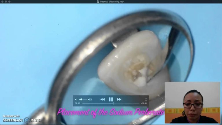Blanqueamiento Dental Interno