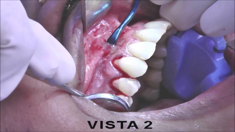 Cirugia Periodontal: tecnica Pinhole para defectos por recesion gingival