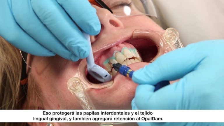 Microabrasion Paso a Paso con Opalustre de Ultradent