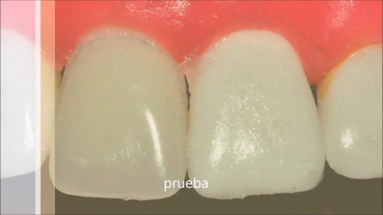 Confeccion de un Provisorio con la Tecnica Diente de Stock