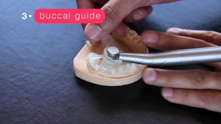 Tecnica First Fit para coronas y puentes dentales en 1 sesion