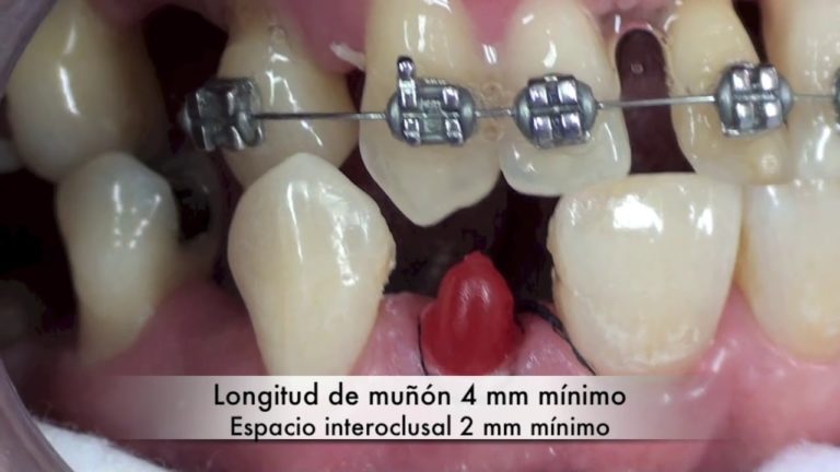 Como hacer un perno dental o poste por metodo directo paso a paso