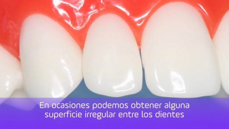 Protocolo de Stripping o desgaste interproximal en dientes