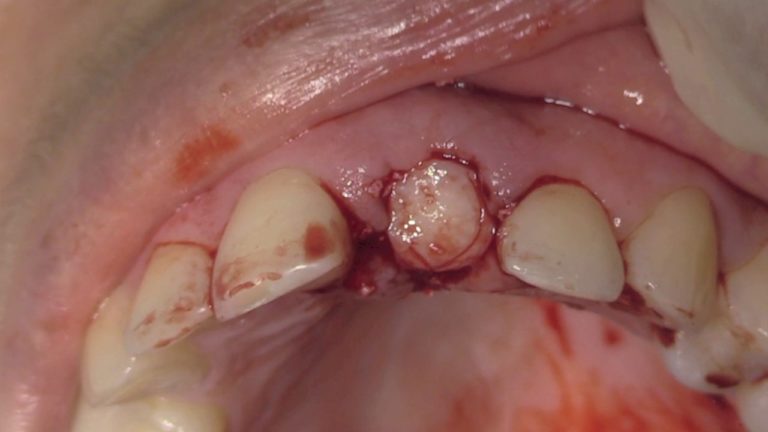 Injerto de espesor total y preservacion alveolar