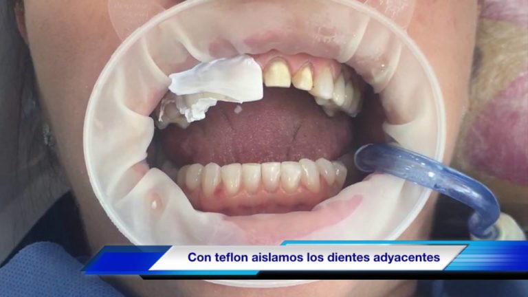 Como cementar carillas ceramicas en diseño de sonrisa- Paso a Paso