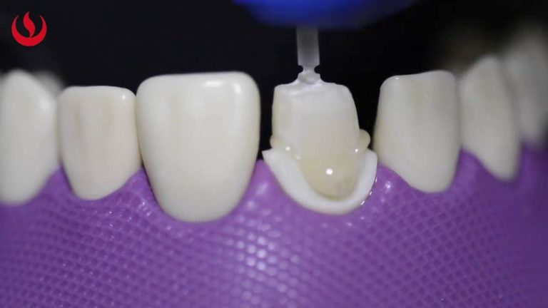 Como hacer un Perno Muñon preformado anatomizado con resina Paso a Paso