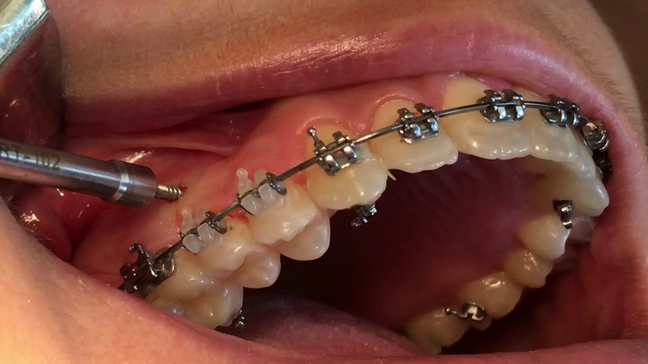 Secuencia Colocacion Microtornillo Ortodoncia dentaltvweb