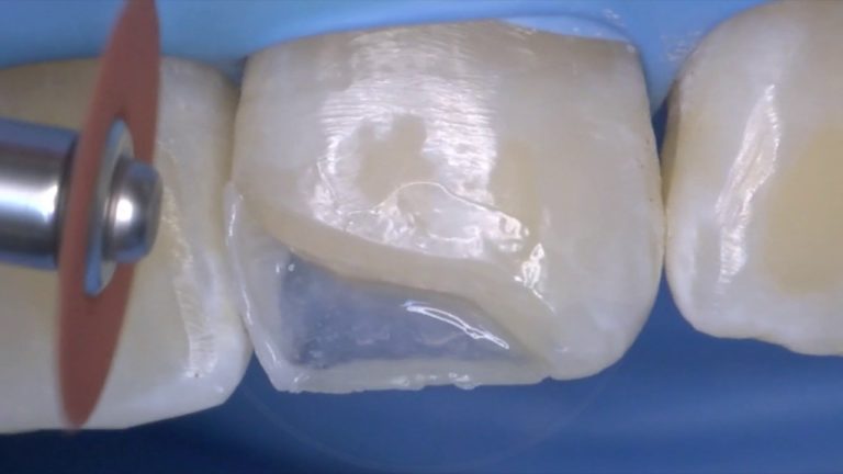 Como restaurar una Clase IV composite