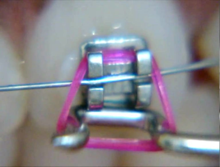 Procedimiento para la sustitucion de los elasticos ortodonticos