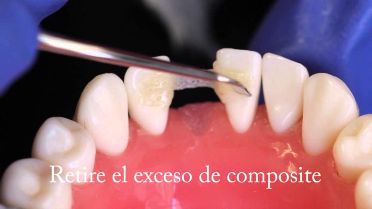 Como hacer un puente en composite dental con una ferula en una sesion paso a paso