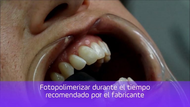 Colocacion Ataches de Composite para Ferulas