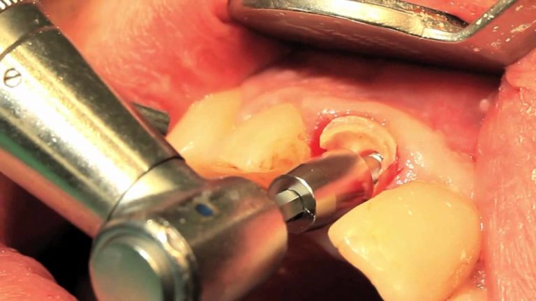 Extracciones dentales mas Simples con extractor a poleas