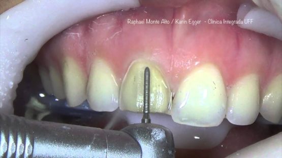 preparacion dentaria para carillas dentales