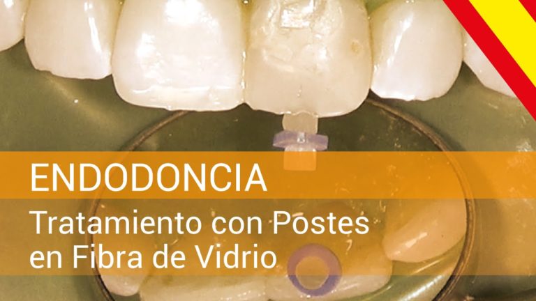 ENDODONCIA – Tratamiento con Postes en Fibra de Vidrio