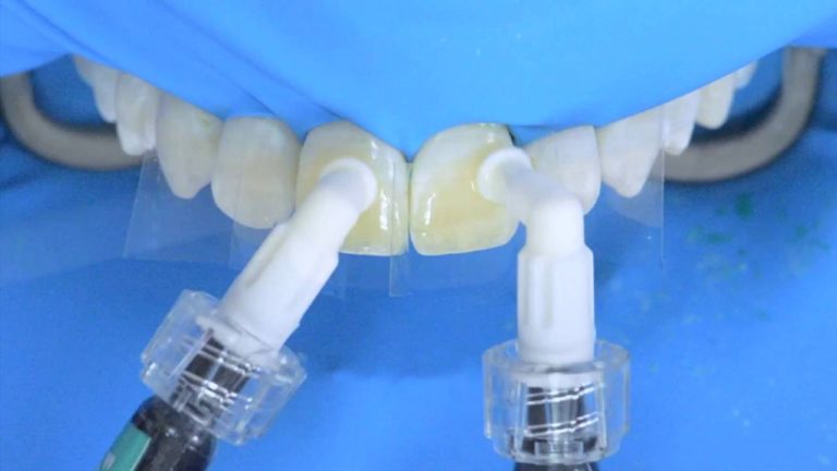 Como eliminar facil manchas de Fluorosis usando Icon, Paso a Paso