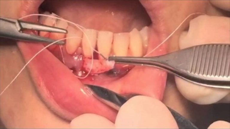 Periodoncia: Tratamiento Recesión Miller Tipo III