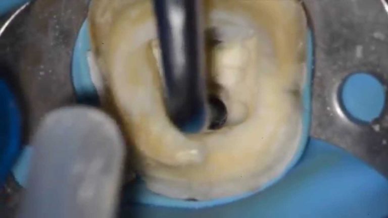 Como remover un poste cementado en una raiz de un diente