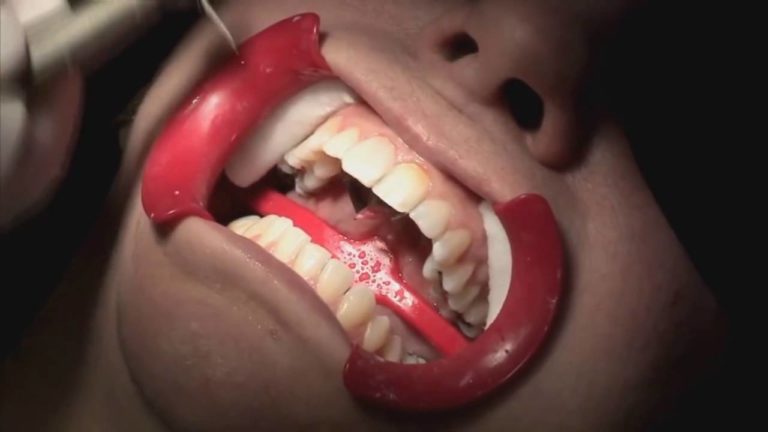 Paso a Paso diseñando una sonrisa con carillas dentales de composite