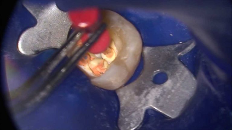 Tratamiento de conducto en 3.7