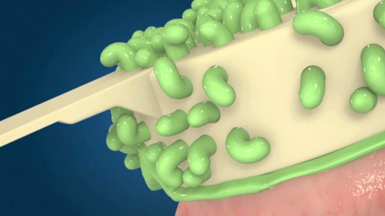 Toma de Impresion para Implantes dentales a Cubeta Cerrada-Paso a Paso