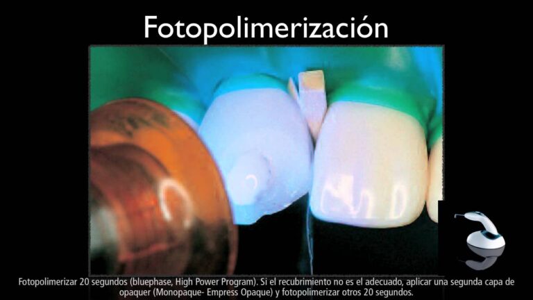 Reparacion de porcelana con composite IPS Empress Direct
