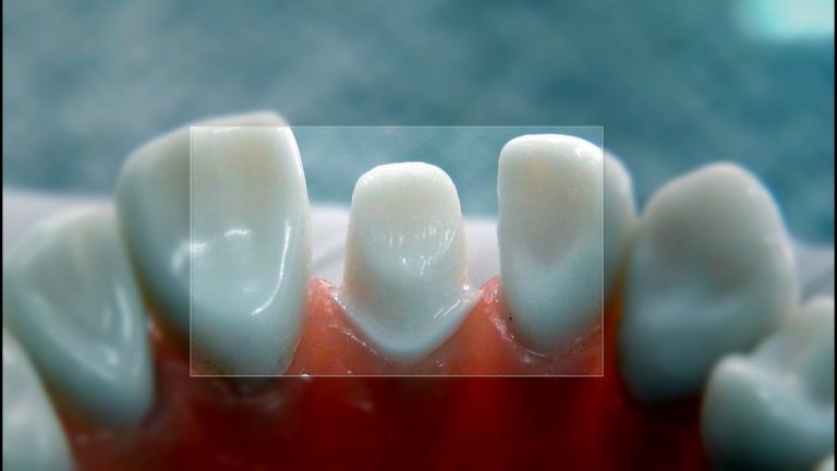 Preparacion dental para corona de ceramica total