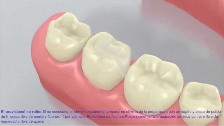 Cementacion de un onlay de ceramica dental