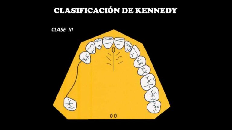 Clasificacion de Kennedy en odontologia para Protesis Dental Parcial Removible