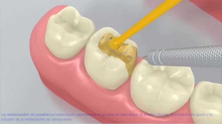 Cementacion inlay dental con cemento adhesivo