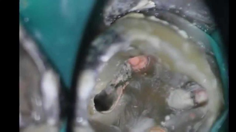 Reparacion de una perforacion usando cemento MTA en diente 46