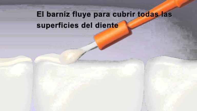 Barniz de fluor dental