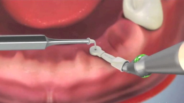 Localizador y detector de Implantes cubiertos por tejidos Blandos