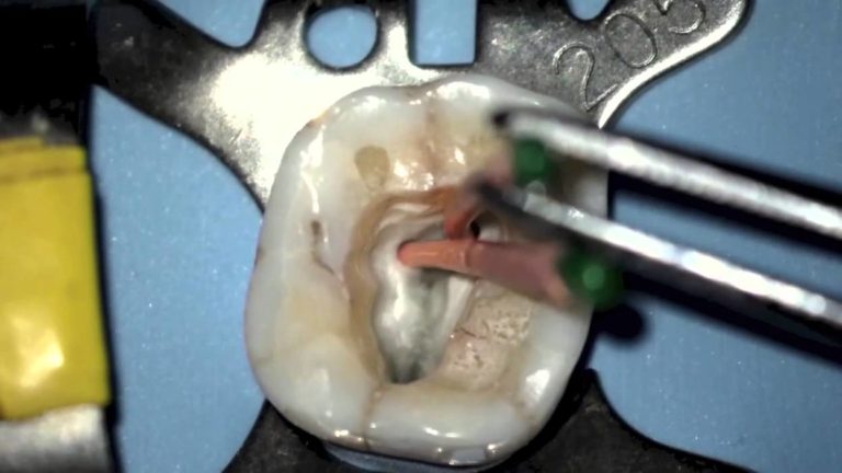 TotalFill cemento endodontico de bioceramica Video PreClinico y Clinico