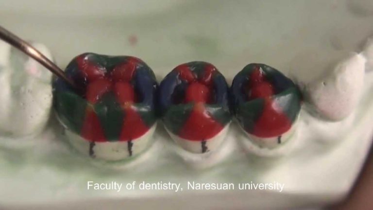 Encerado de piezas dentales posteriores