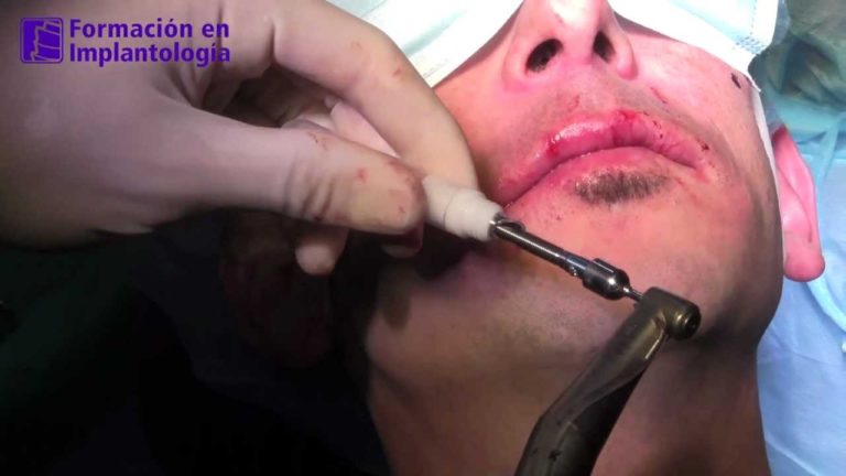 Implantes Cigomaticos